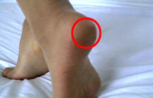 经常有人足跟痛，那是无缘看此方