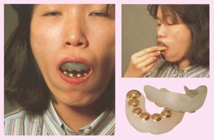 啃咬能力增强假牙